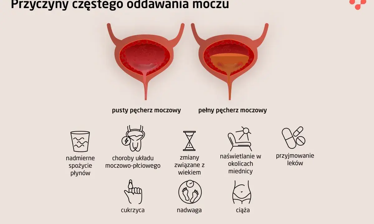 Ilustracja pokazuje pęcherz pusty i pełny, wyjaśniając przyczyny częstego oddawania moczu: nadmierne picie, choroby, wiek, naświetlanie, leki, cukrzyca, nadwaga, ciąża.