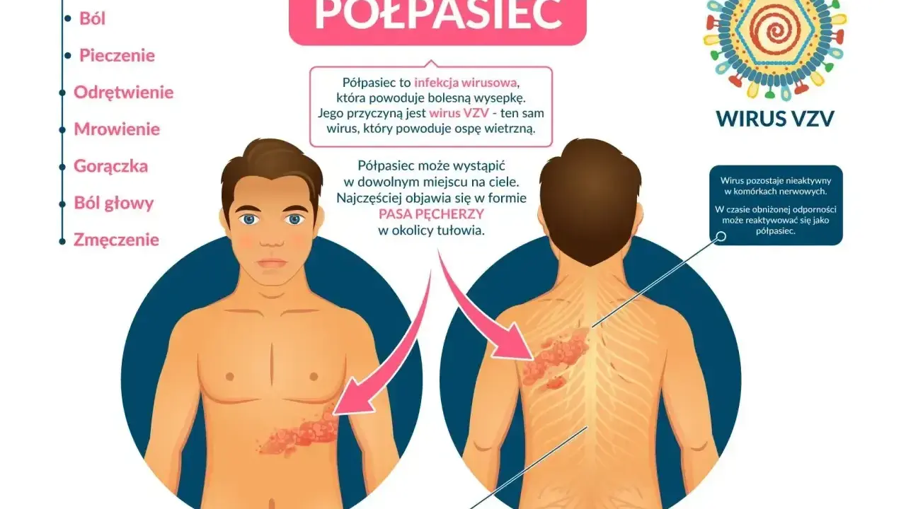 Ilustracja przedstawia objawy półpaśca, w tym ból, pieczenie i wysypkę na ciele, wskazując na nietypowe objawy półpaśca.