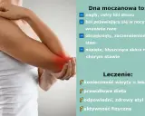 Dna moczanowa objawia się nagłym bólem stawu, zaczerwienieniem i obrzękiem. Leczenie obejmuje wizytę u lekarza, dietę i aktywność fizyczną.