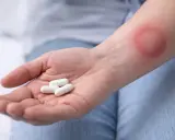 Dłoń z kilkoma białymi kapsułkami, obok zaczerwienienie na skórze sugerujące boreliozę i potrzebę antybiotyku.