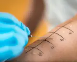 Ręka z zaznaczonymi polami do testów alergicznych skórnych. Igła wprowadza alergen, rozpoczynając diagnostykę.