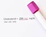 Wynik cholesterolu 299 mg/dL, co oznacza wysoki poziom. Wartość referencyjna to 150-250.
