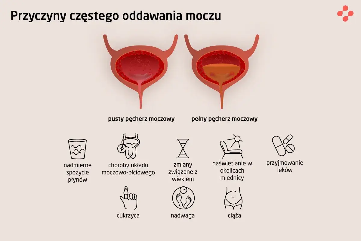 Ilustracja pokazuje pęcherz pusty i pełny, wyjaśniając przyczyny częstego oddawania moczu: nadmierne picie, choroby, wiek, naświetlanie, leki, cukrzyca, nadwaga, ciąża.