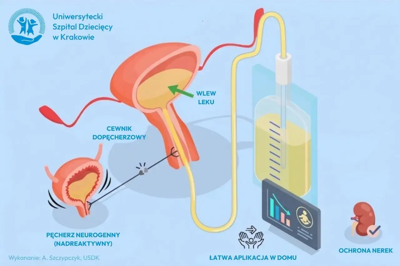 Ilustracja przedstawia cewnikowanie pęcherza neurogennego. Wlew leku, np. Solinco 5 mg, ułatwia aplikację w domu, chroniąc nerki.