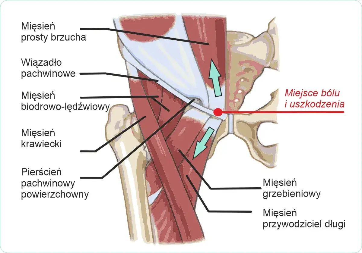 Anatomia pachwiny z zaznaczonym miejscem bólu i uszkodzenia. Może pomóc w doborze tabletek na ból pachwiny.