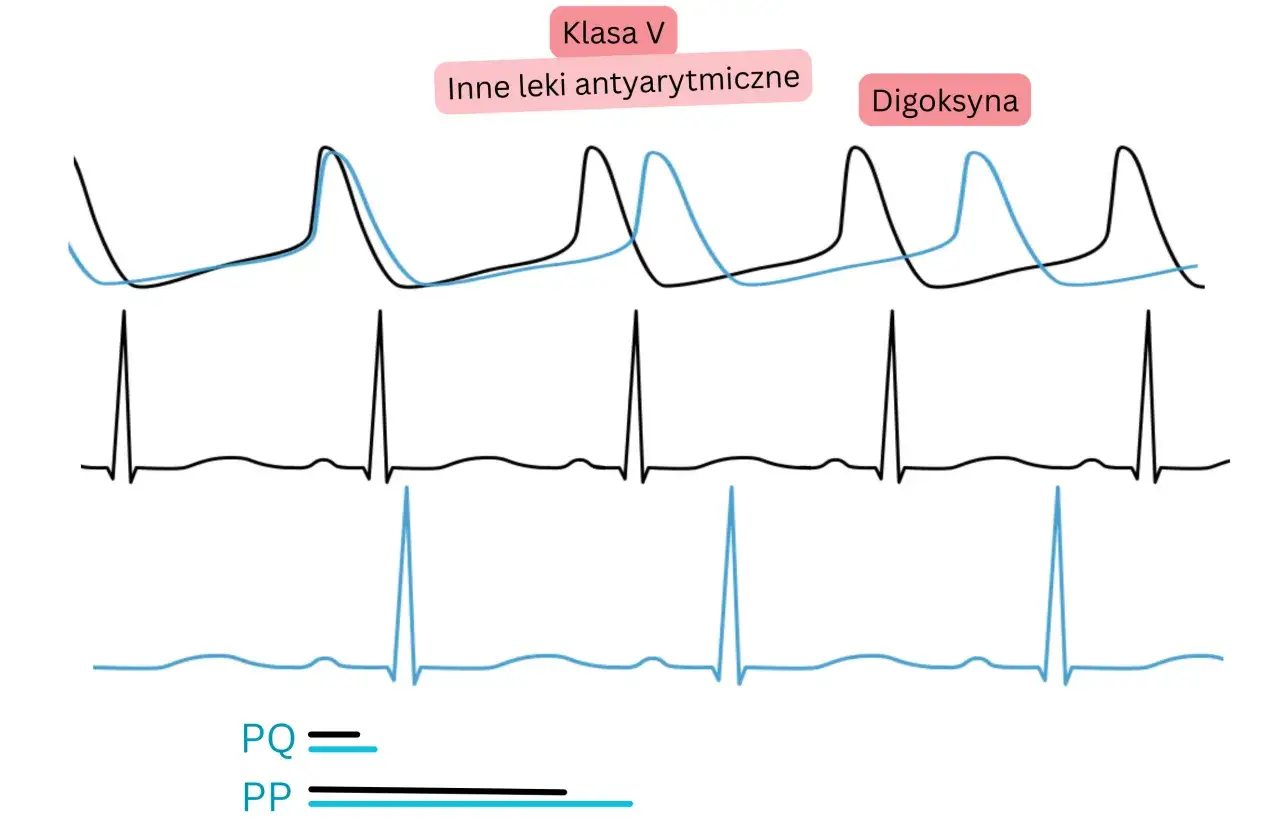Wykresy EKG pokazujące wpływ digoksyny na rytm serca. Digoksyna jest lekiem antyarytmicznym klasy V.