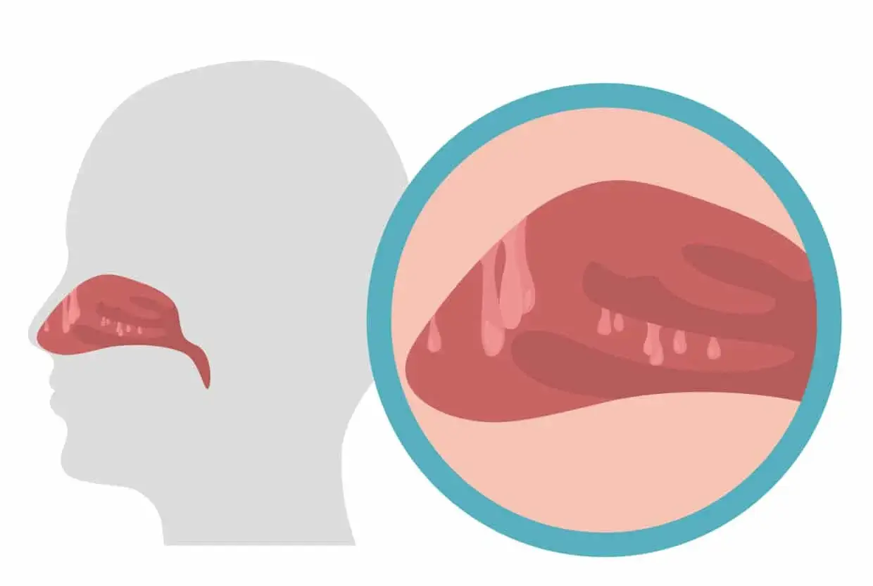 Ilustracja przedstawia profil głowy z zaznaczonymi polipami w nosie. Powiększony fragment ukazuje szczegółowo te łagodne narośla.
