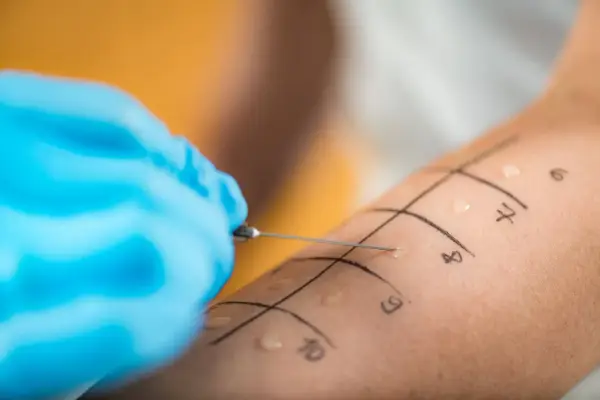 Ręka z zaznaczonymi polami do testów alergicznych skórnych. Igła wprowadza alergen, rozpoczynając diagnostykę.